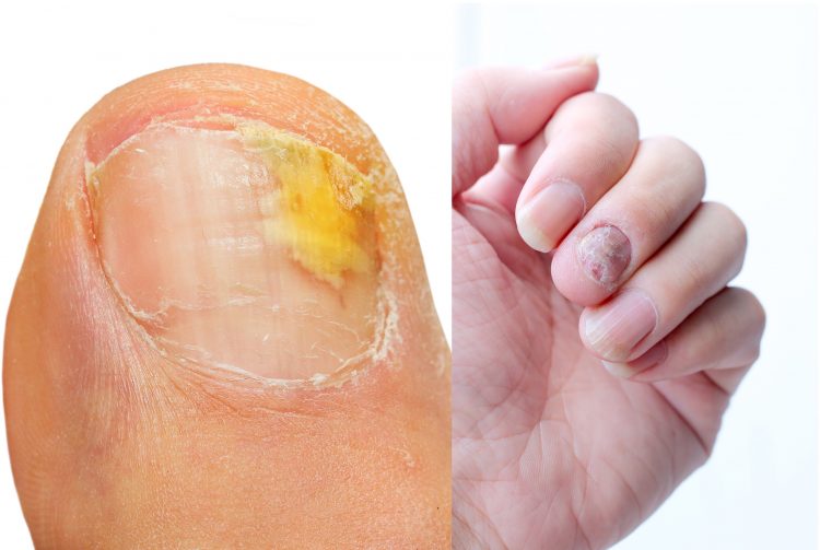 Mikaly Nail Fungus Oil
