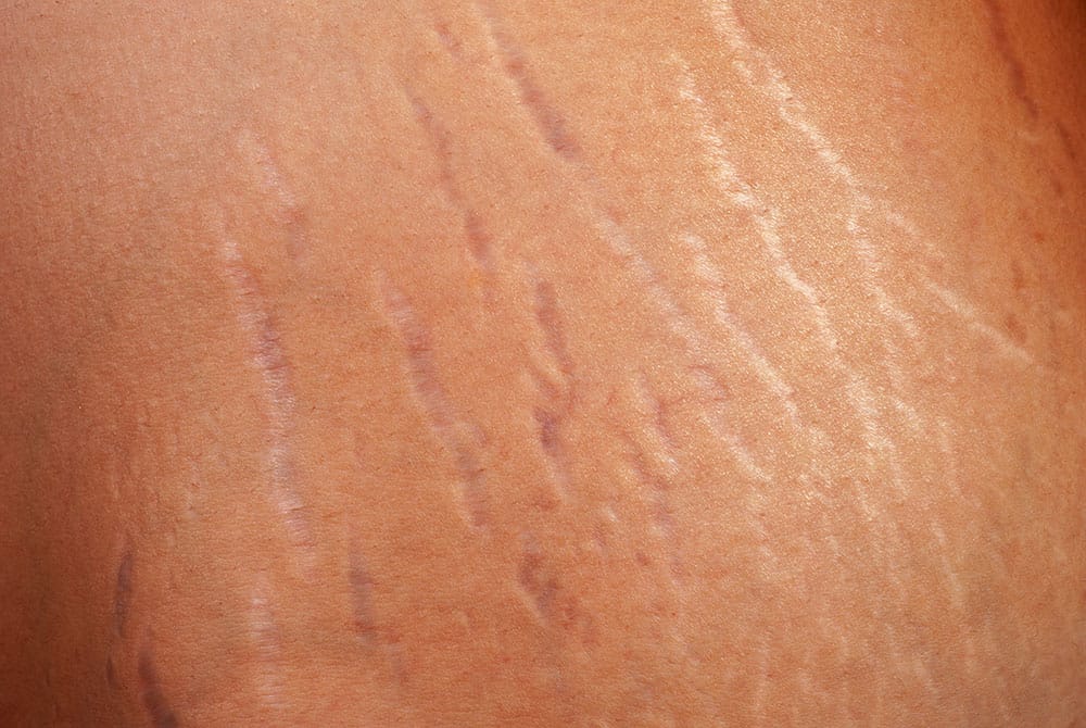 Jabon Anti-estrias