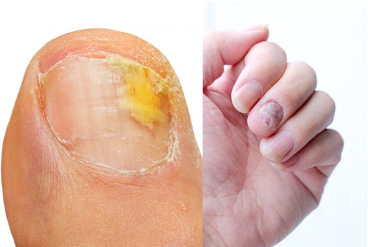 Mikaly Nail Fungus Oil