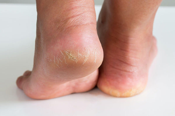 Removedor de callos en gel